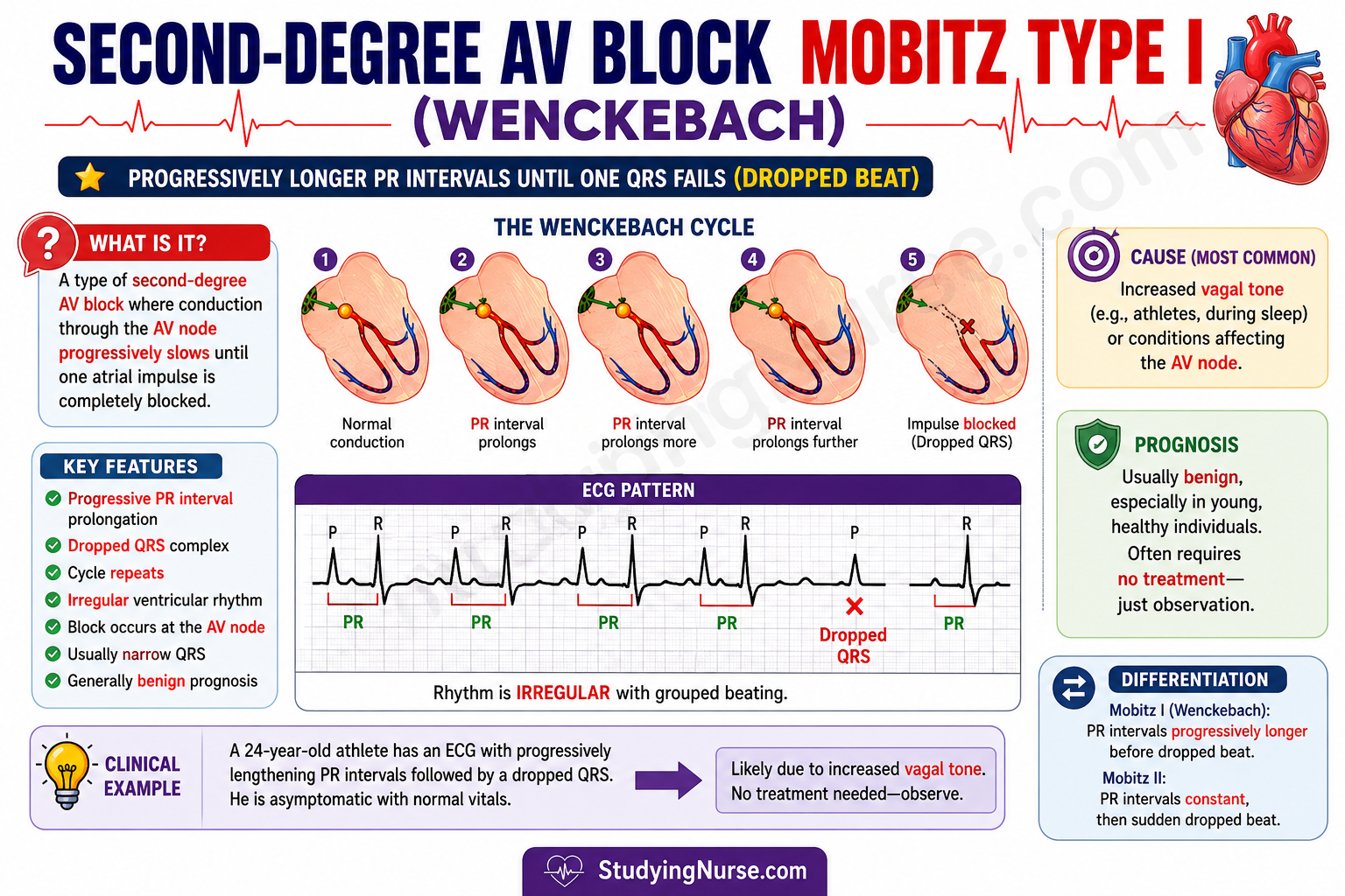 Second-Degree AV Block (Mobitz Type I / Wenckebach): A Complete Nursing ...